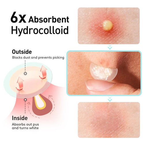 Invisible Acne Absorbing Patches